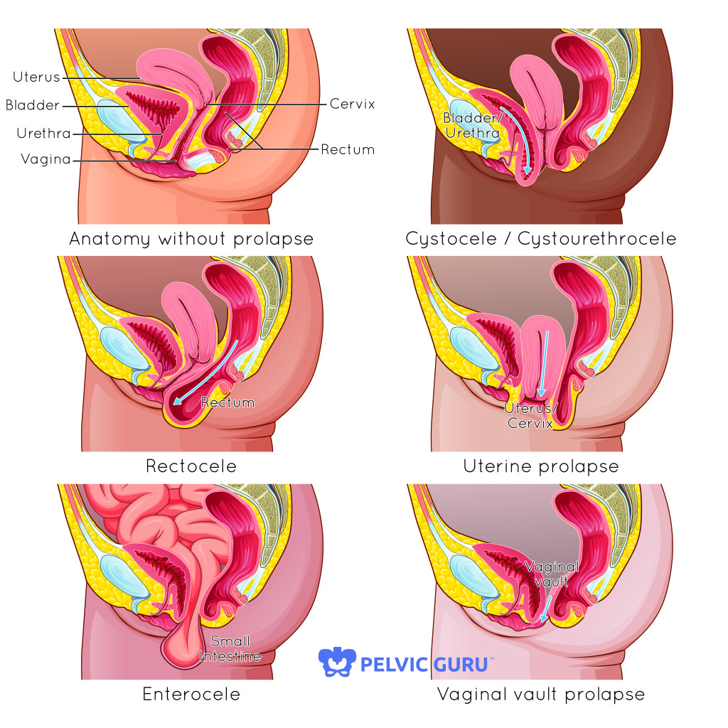 The Do's and Don'ts of Pelvic Organ Prolapse - Hudson Valley Physical  Therapy